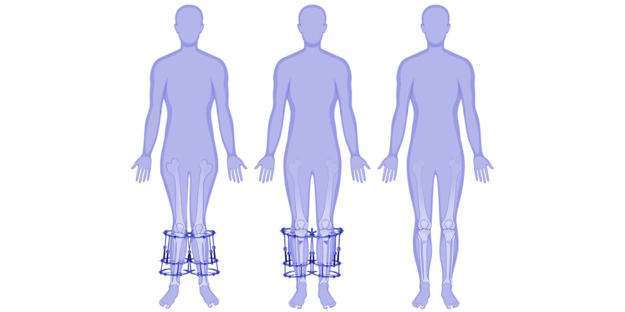 X-Type Legs (Knock Knees)