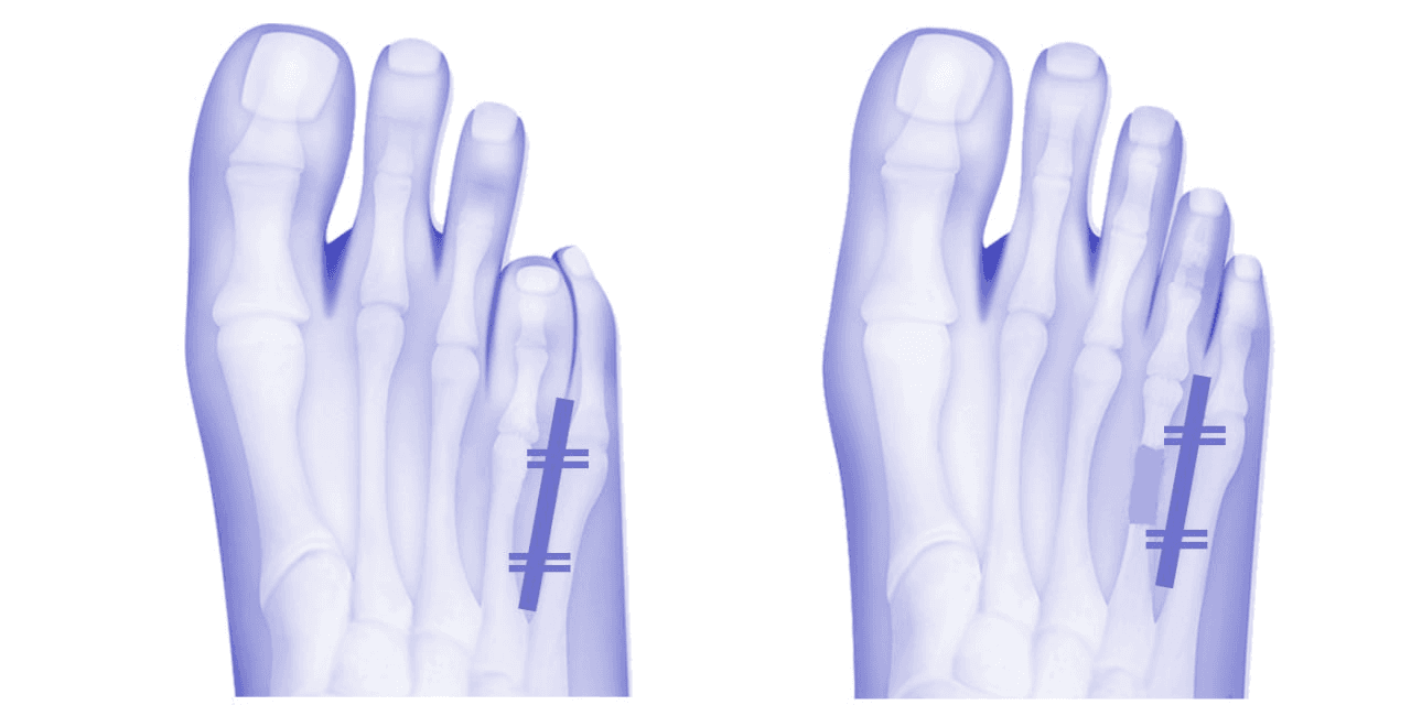Foot and ankle surgery