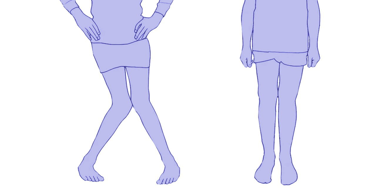 Multiple deformities