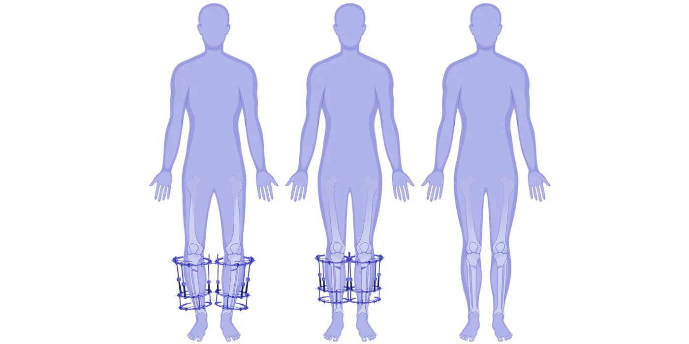 O-Type Legs (Bowlegs)