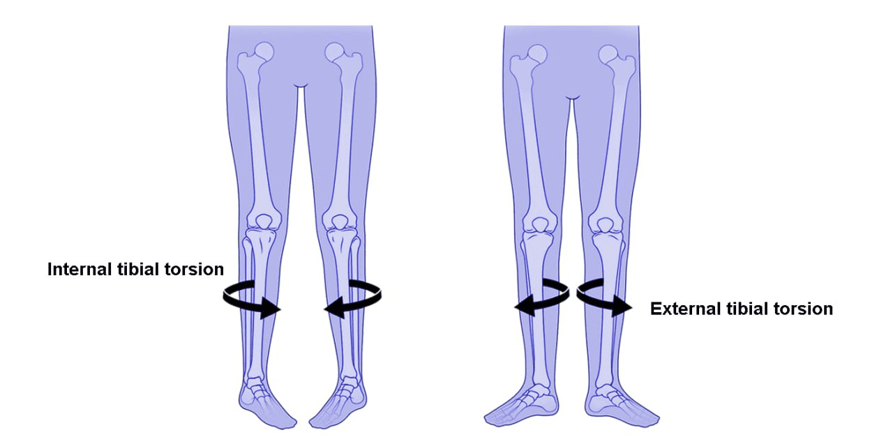 Torsional deformities