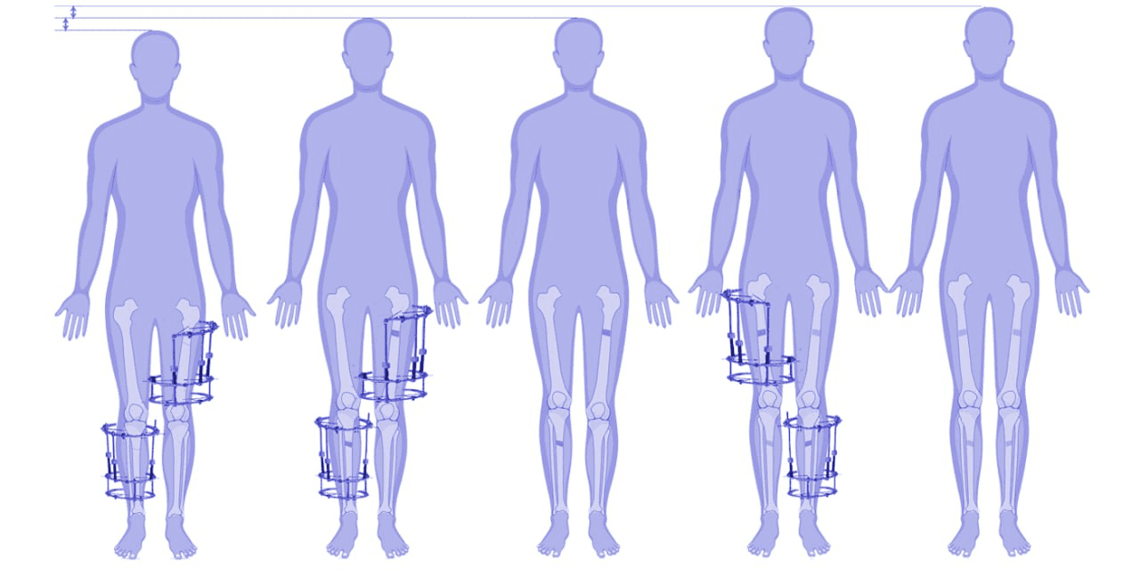 Stature Lengthening by Classical Ilizarov Method