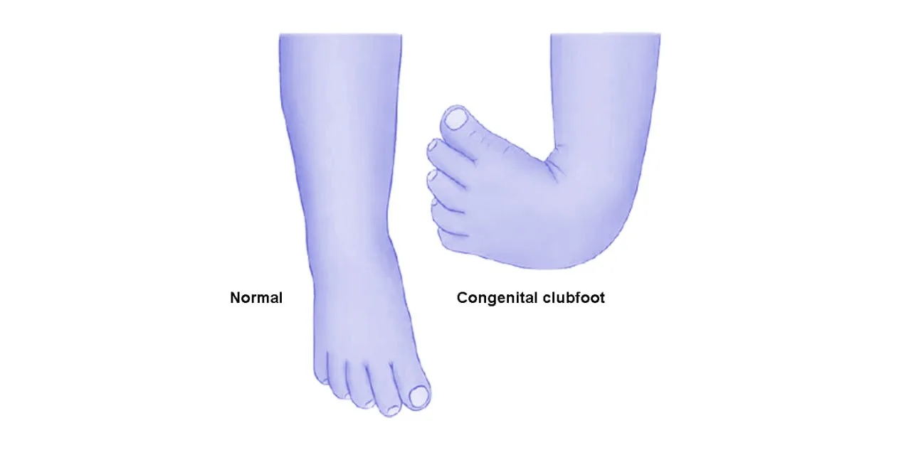 Clubfoot