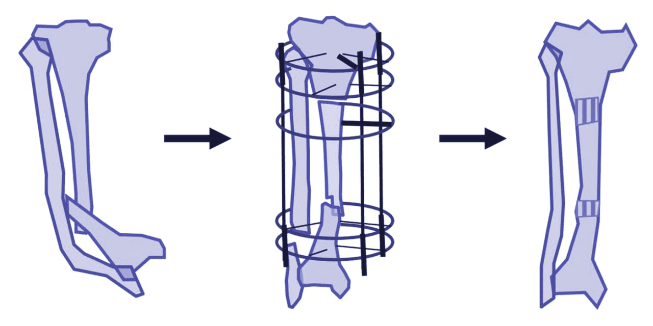 Congenital Pseudoarthrosis