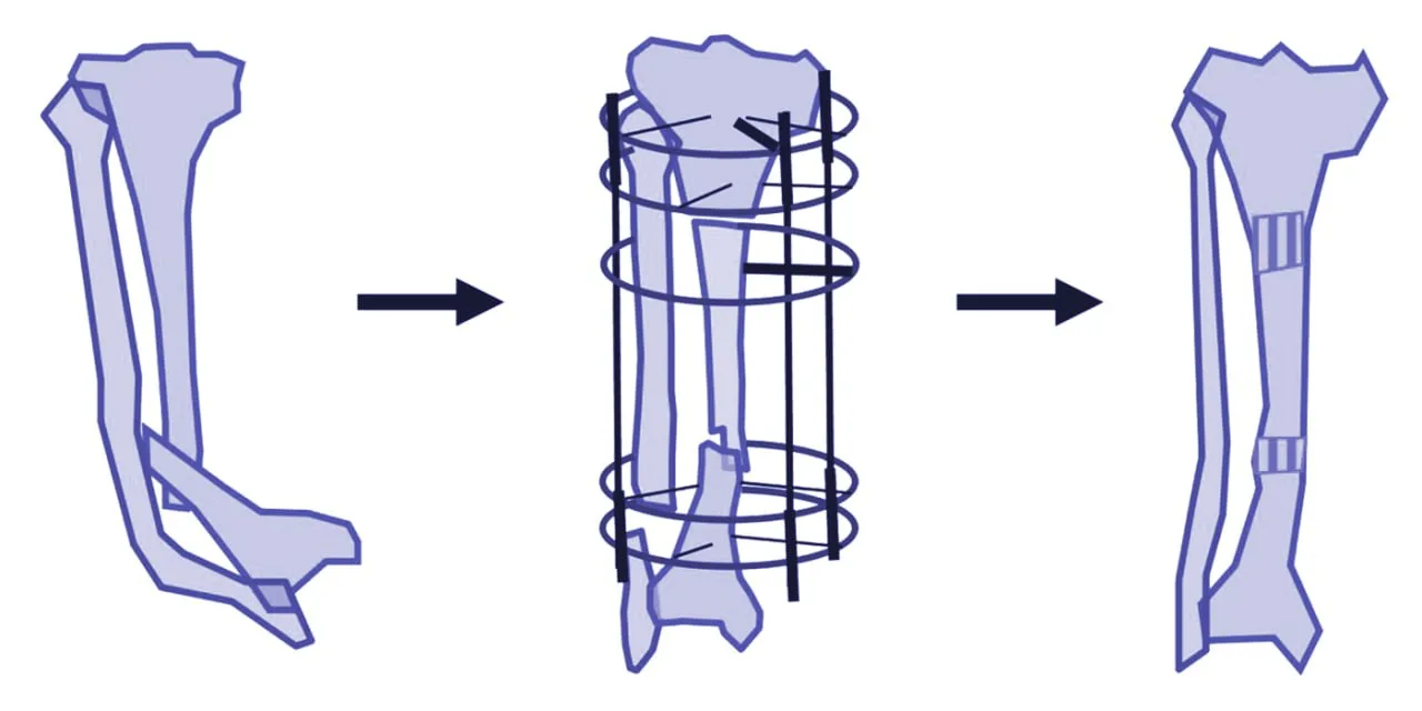 Congenital Pseudoarthrosis