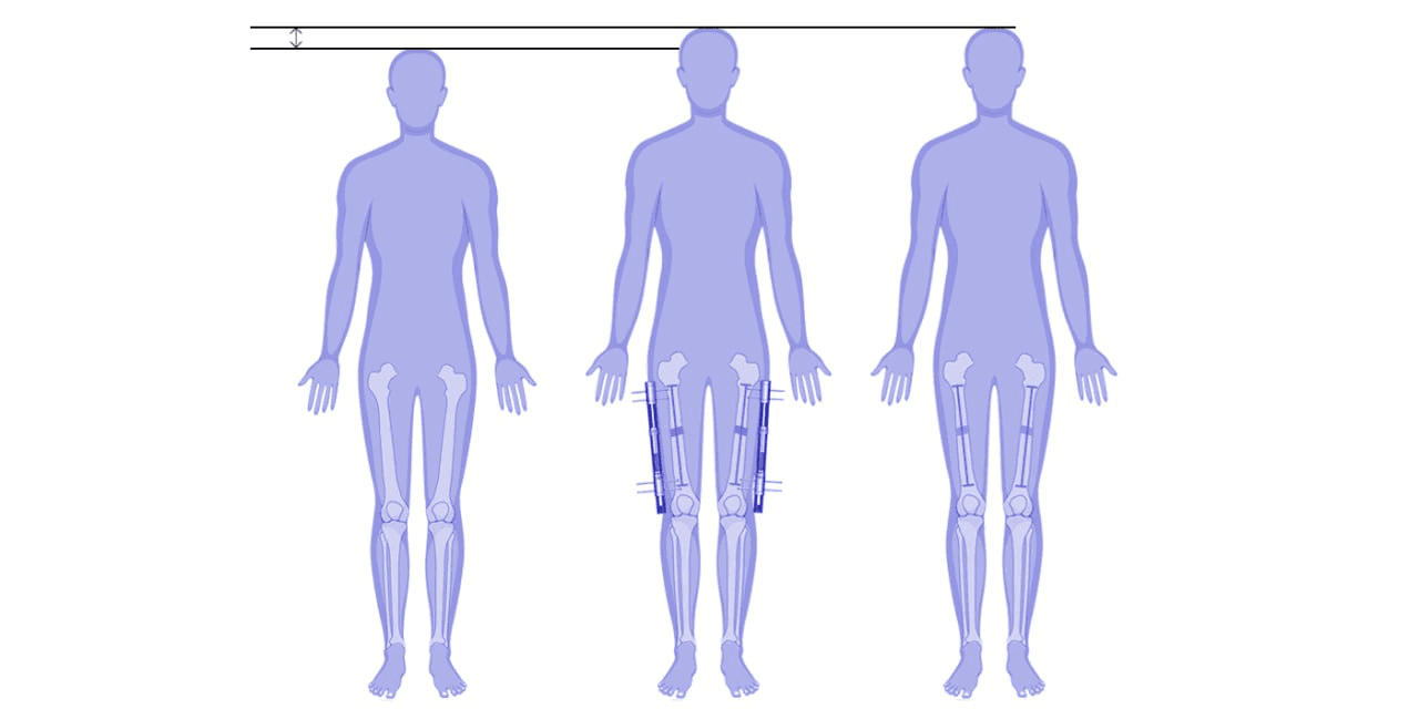 Femur lengthening surgery