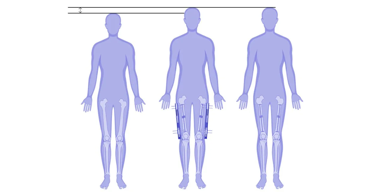 Femur lengthening surgery