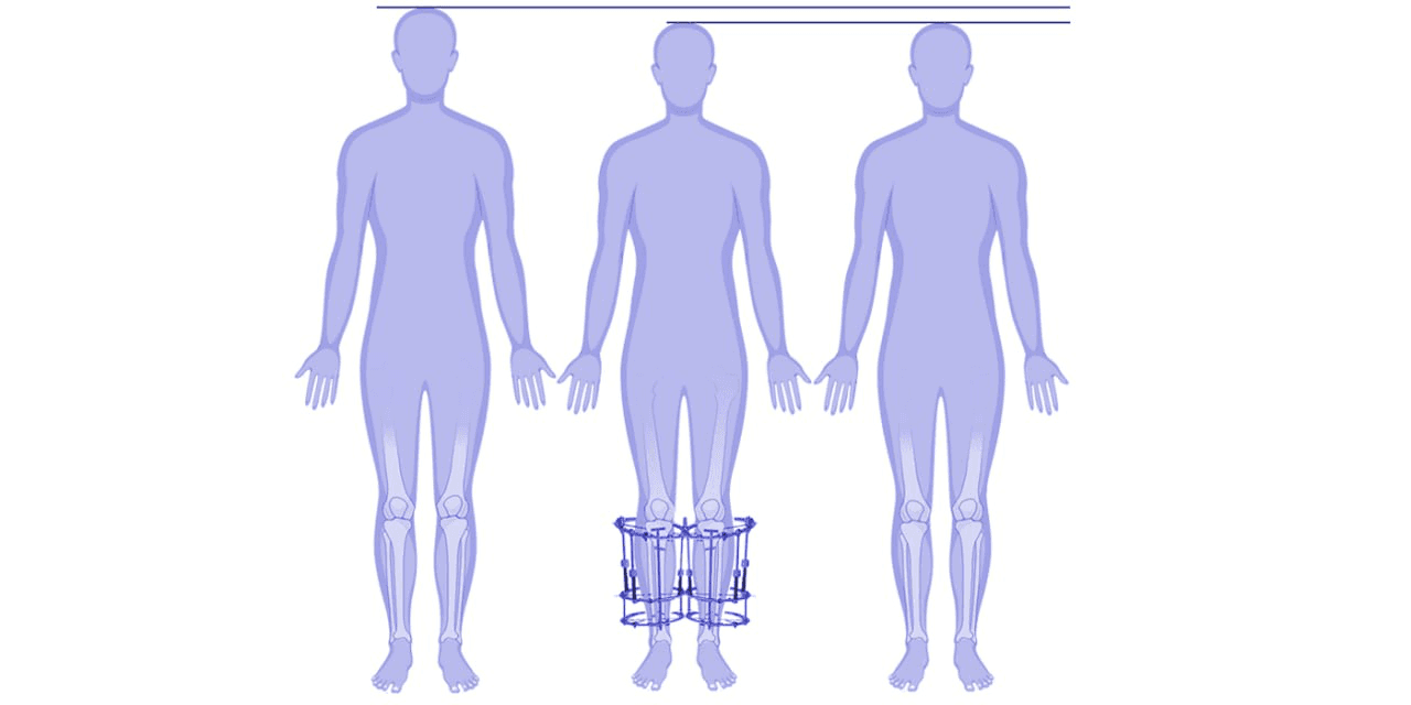 Limb shortening surgery