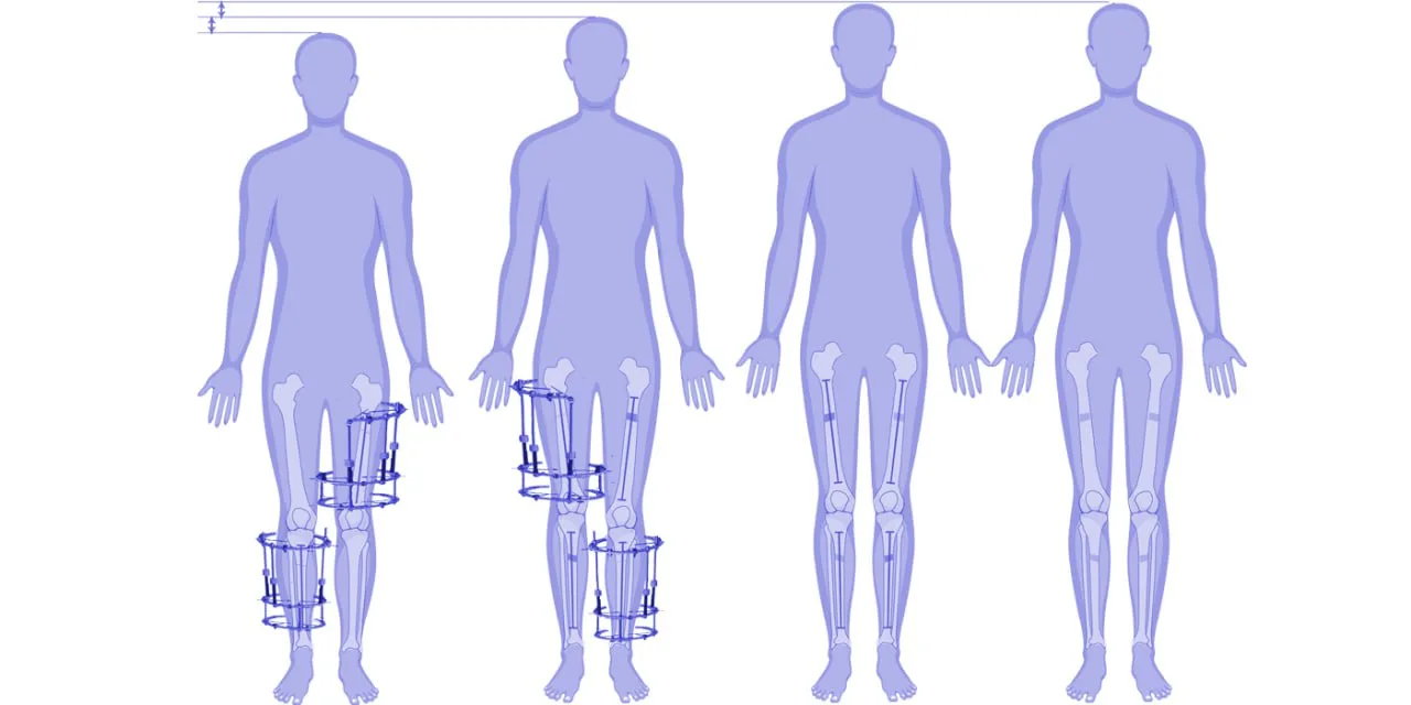 Stature Lengthening by LON/LATN Method
