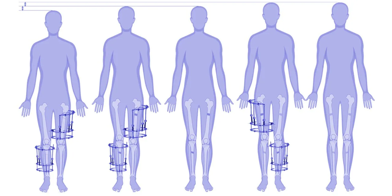 Stature Lengthening by Classical Ilizarov Method