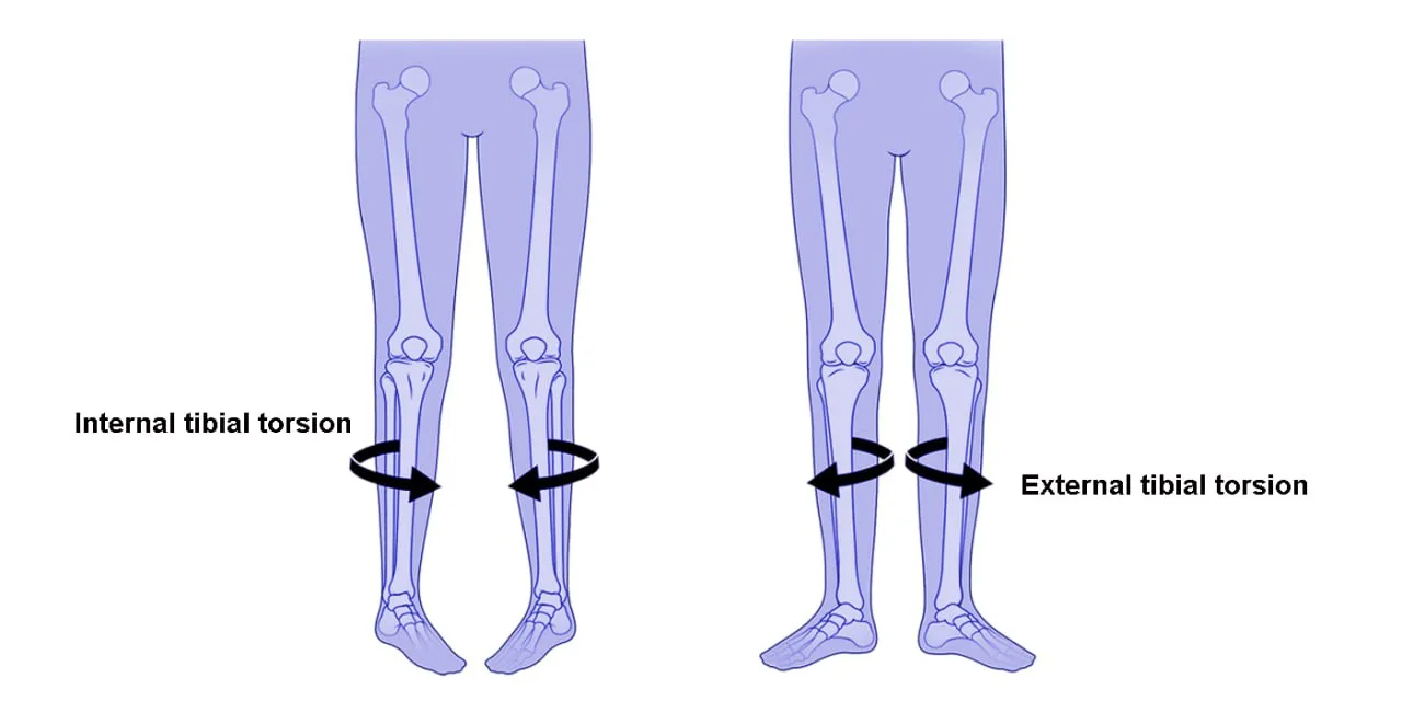 Torsional deformities
